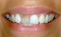 Missing, Discoloured or Damaged teeth