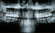 Impacted Wisdom Teeth