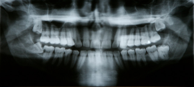 Impacted Wisdom Teeth