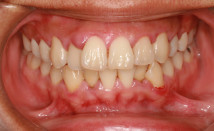 Bleeding Gums, Gum Disease and Receding Gums with Sensitive Teeth