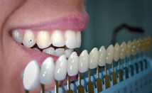 Cosmetic Fillings, Bonding and Tooth Whitening